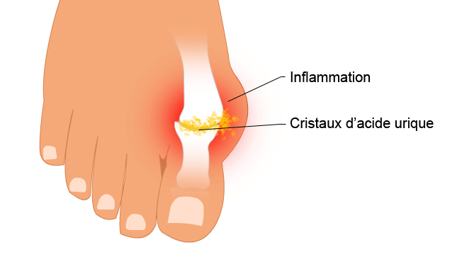 Comment soulager une crise de goutte sans médicaments ? : Schéma de la crise de goutte